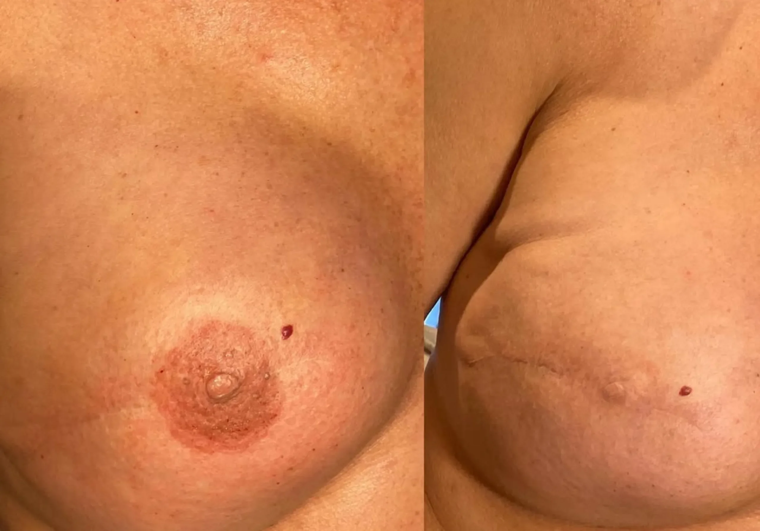 post mastectomy nipple tattoo