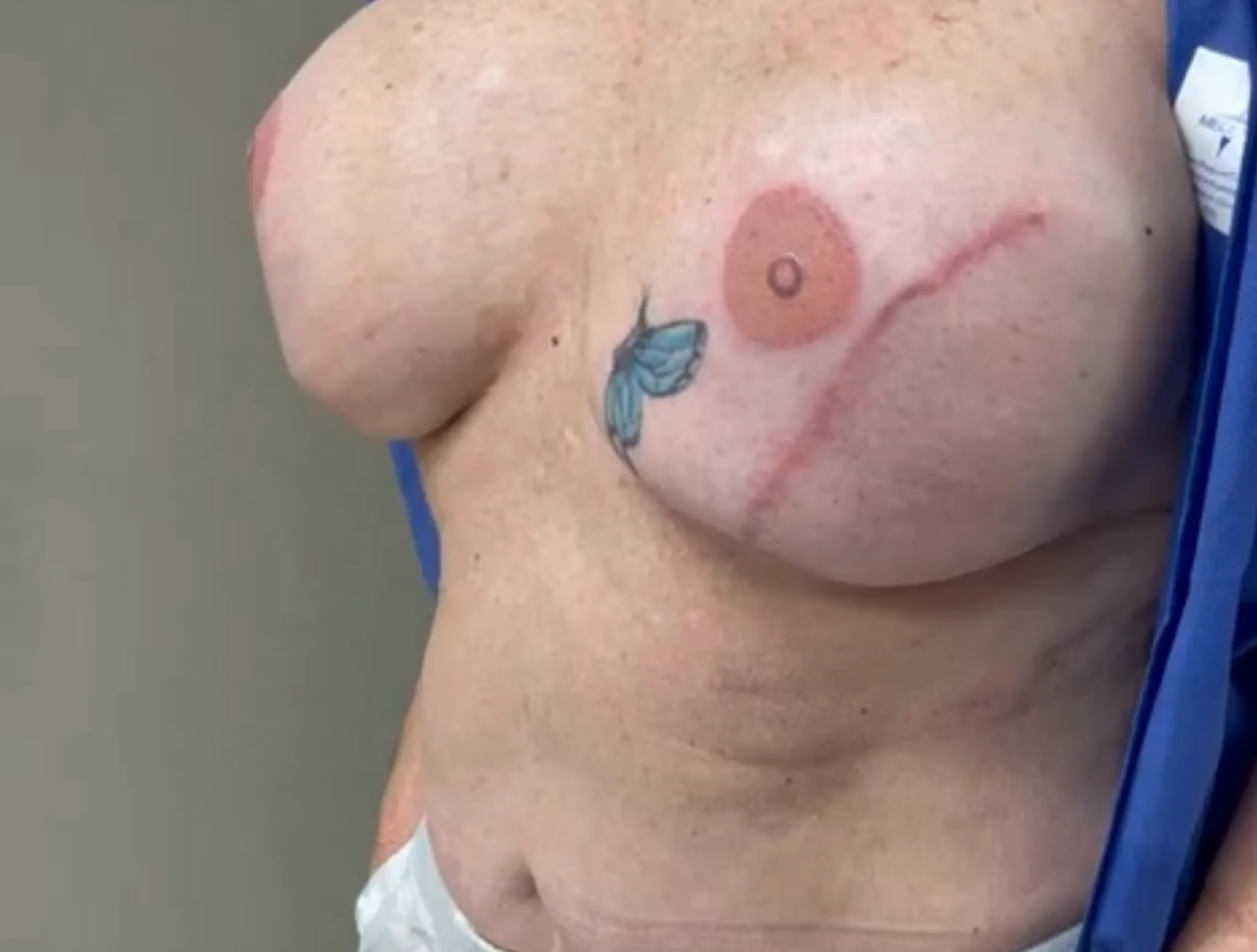 restorative areola tattoo Victoria